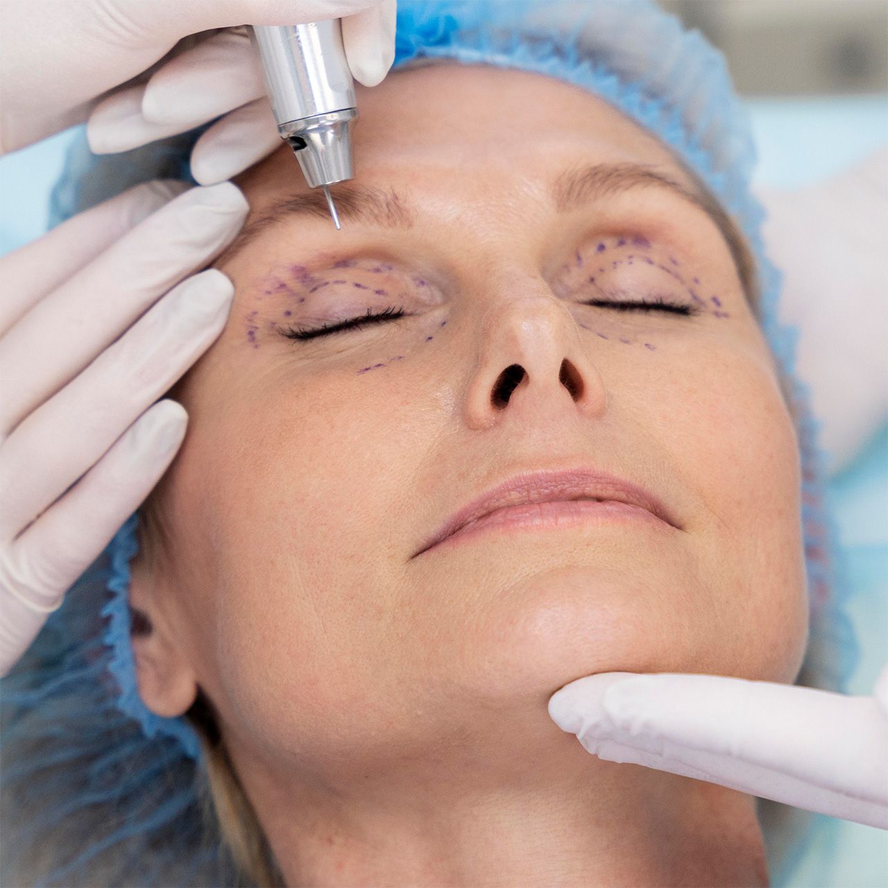 göz kapağı estetiği