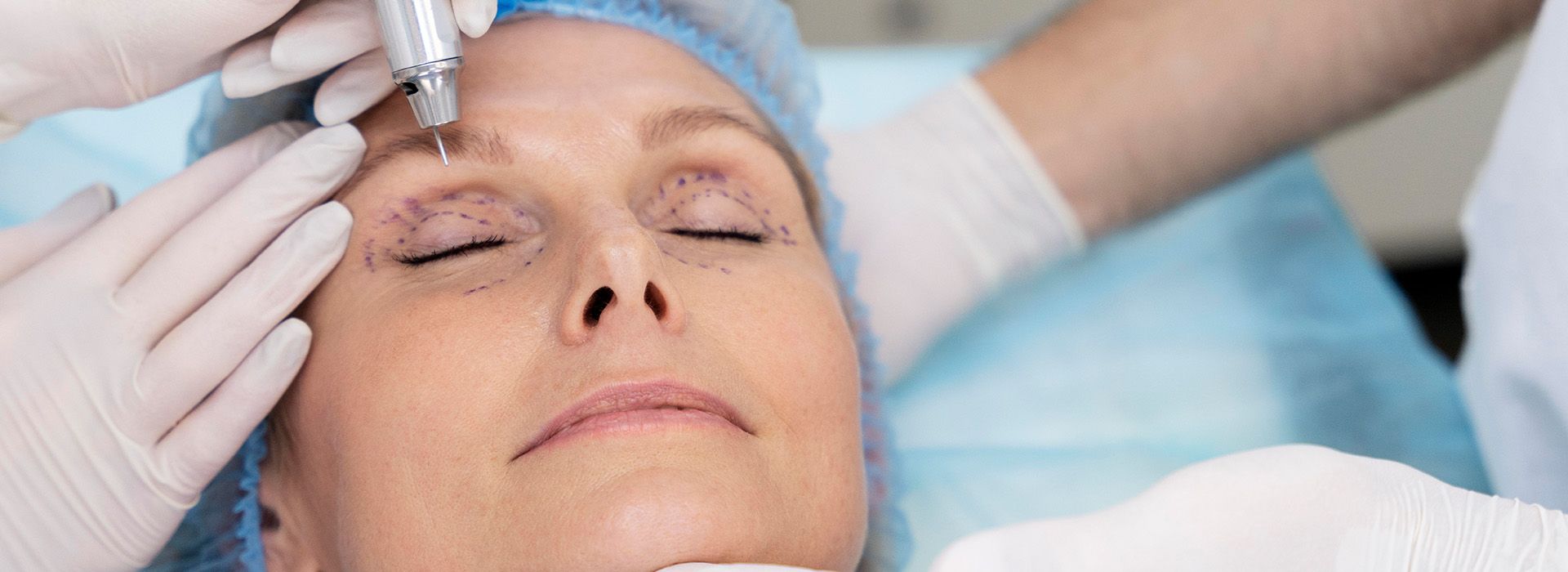 göz kapağı estetiği